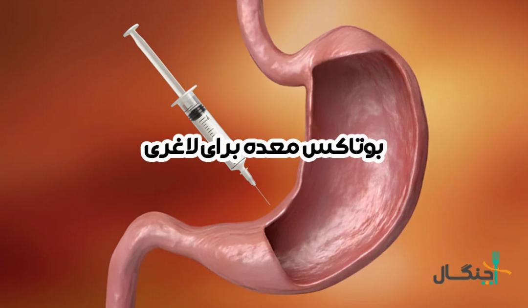 بوتاکس معده برای لاغری: روش انجام، مزایا و عوارض