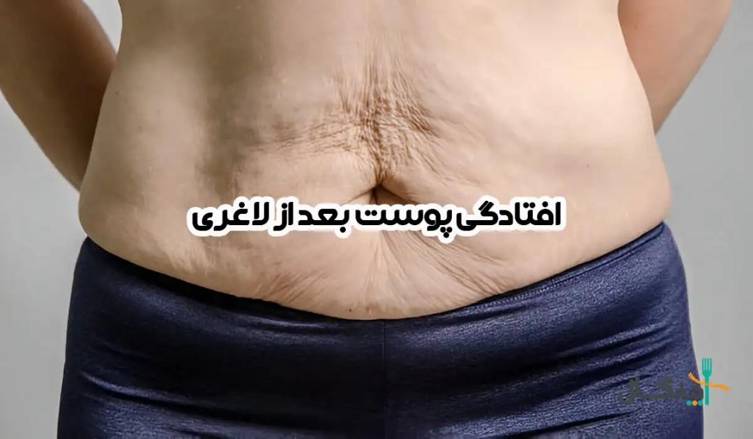 افتادگی پوست بعد از لاغری؛ چرا اتفاق می‌افتد و چگونه قابل پیشگیری و درمان است؟