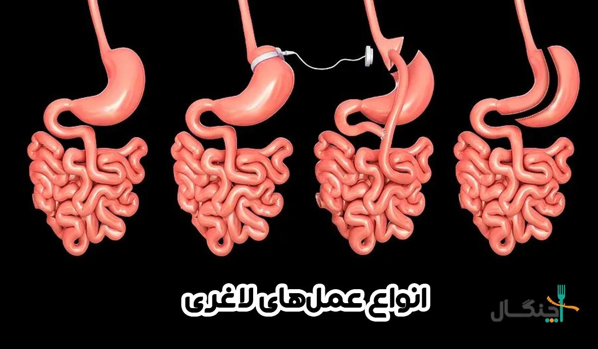 عمل های لاغری؛ انواع عمل لاغری + مزایا و ریسک‌ها