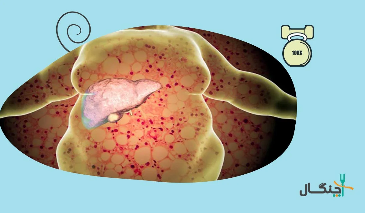 چاقی، بزرگترین عامل ابتلا به کبد چرب است.